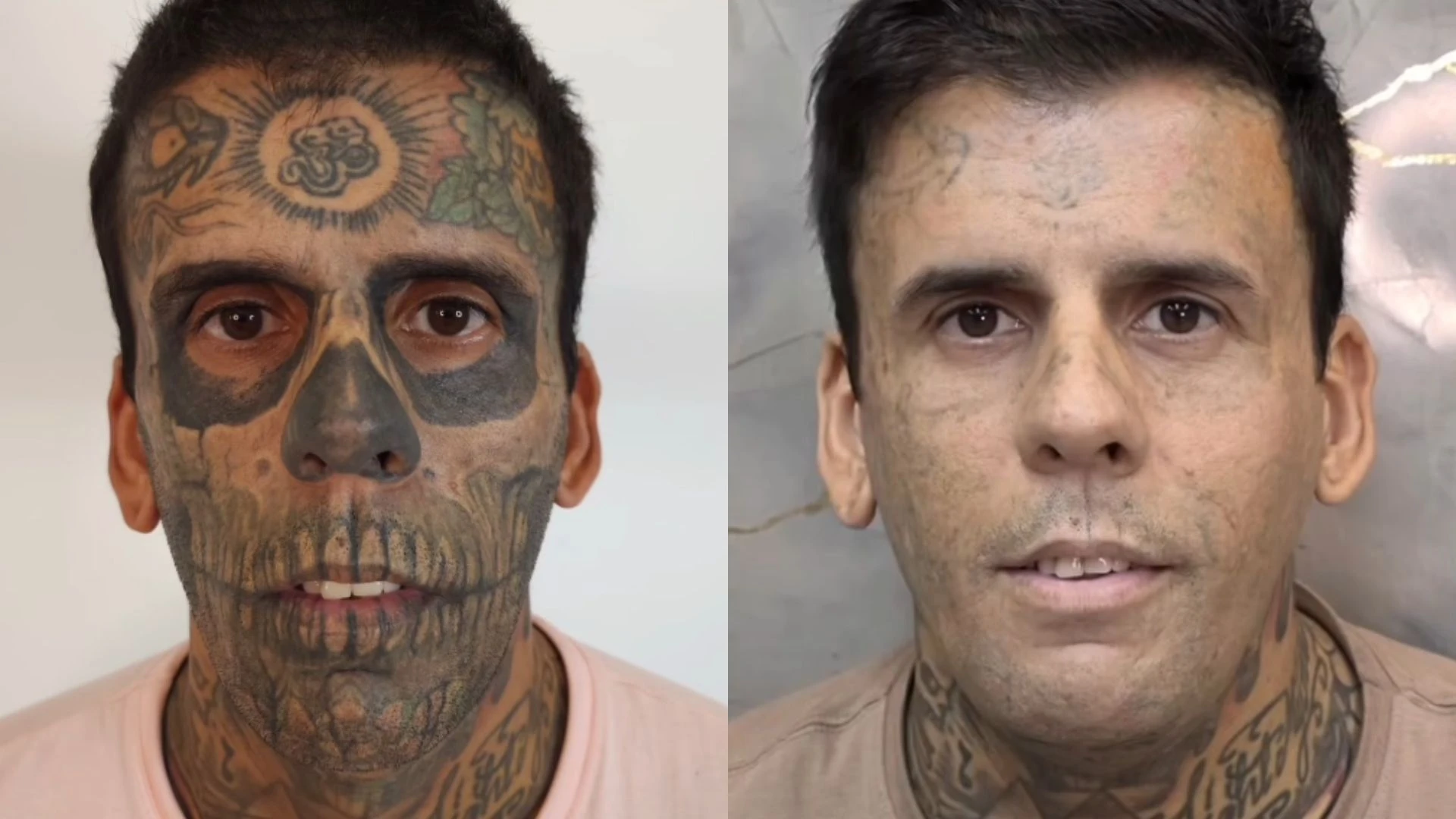 Mais tatuado do Brasil passa por nova remocao e.webp