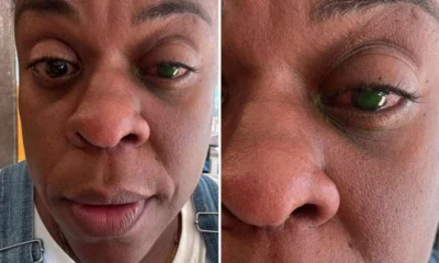 Cega Cacau Protasio tem perda de visao apos usar.webp