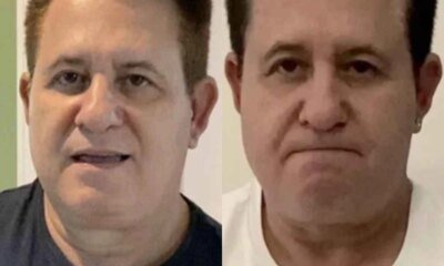 Marrone vai para a mesa de cirurgia e informacao acaba