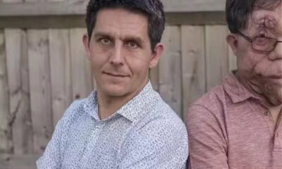 Tudo sobre Adam Pearson ator com Neurofibromatose uma doenca genetica