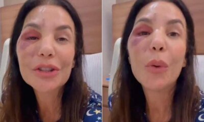 ‘Quebrei esses dois ossos Ivete Sangalo e submetida a cirurgia
