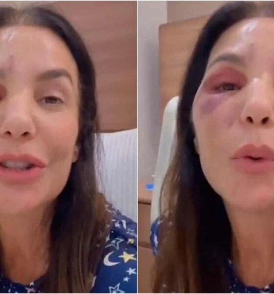 ‘Quebrei esses dois ossos Ivete Sangalo e submetida a cirurgia
