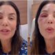 ‘Quebrei esses dois ossos Ivete Sangalo e submetida a cirurgia