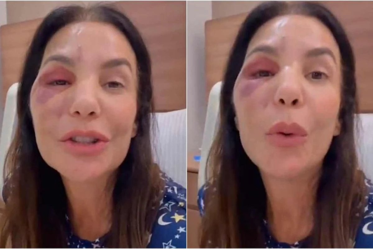 ‘Quebrei esses dois ossos Ivete Sangalo e submetida a cirurgia