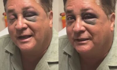 Apanhou Cantor Leonardo aparece com olho roxo e motivo vem