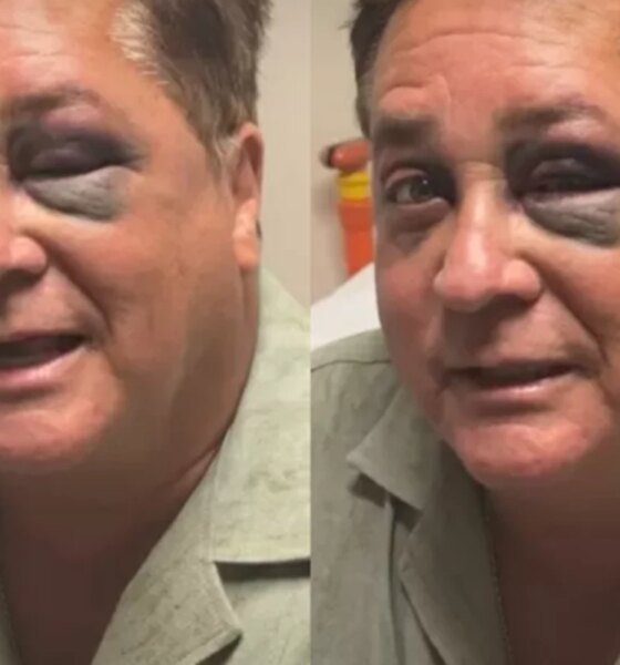 Apanhou Cantor Leonardo aparece com olho roxo e motivo vem