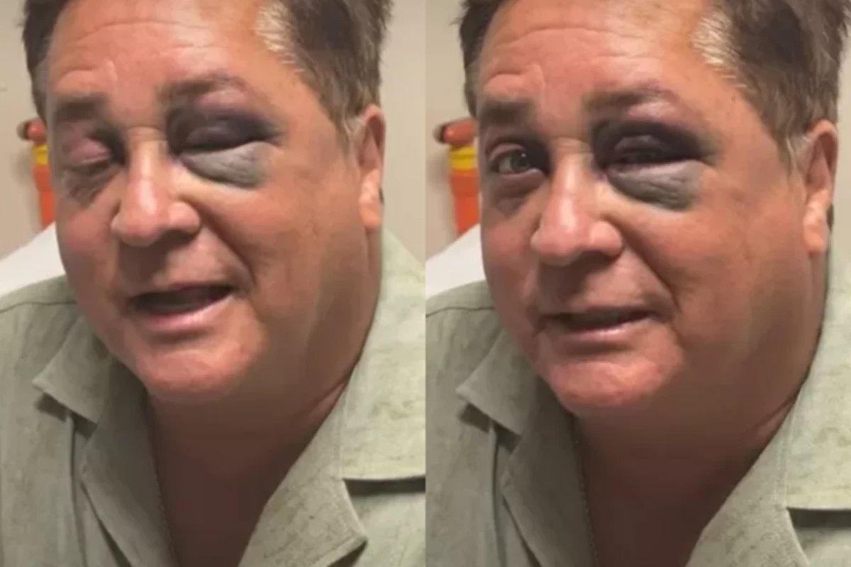 Apanhou Cantor Leonardo aparece com olho roxo e motivo vem