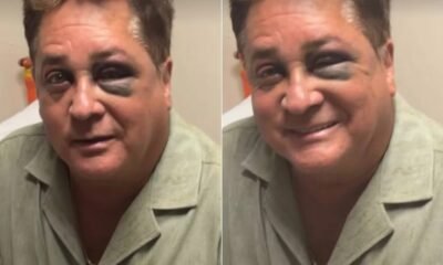 Cantor Leonardo surge com olho roxo apos acidente e Poliana