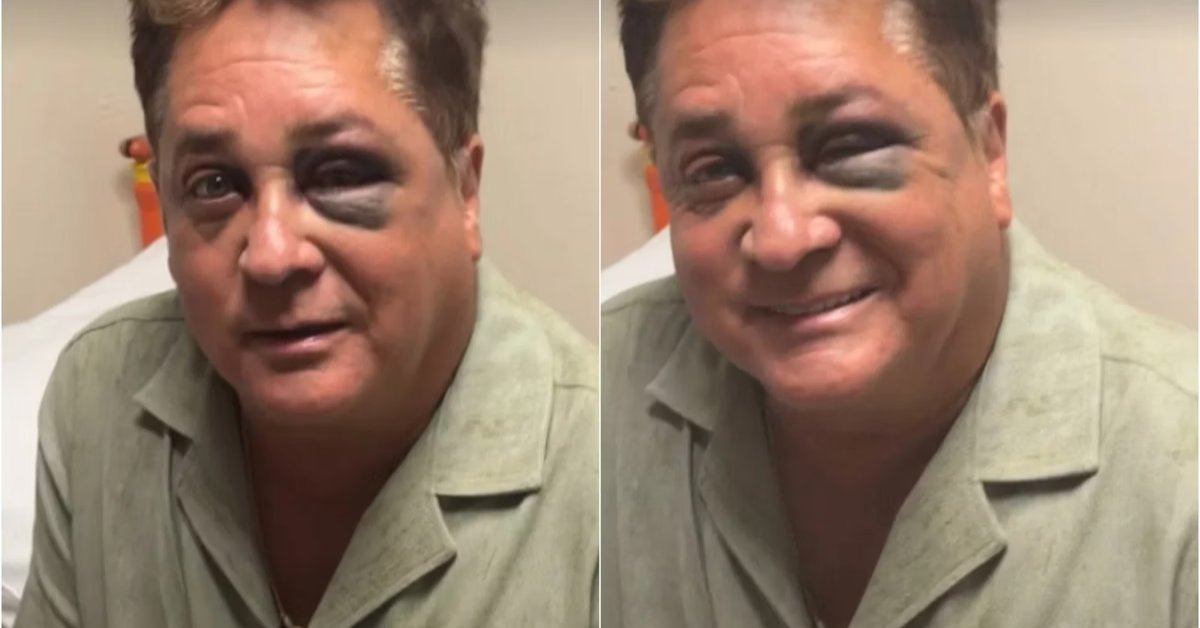 Cantor Leonardo surge com olho roxo apos acidente e Poliana