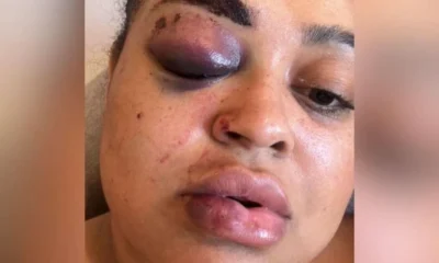 Ex BBB sofre acidente grave e relata apagao Nao lembrava.webp