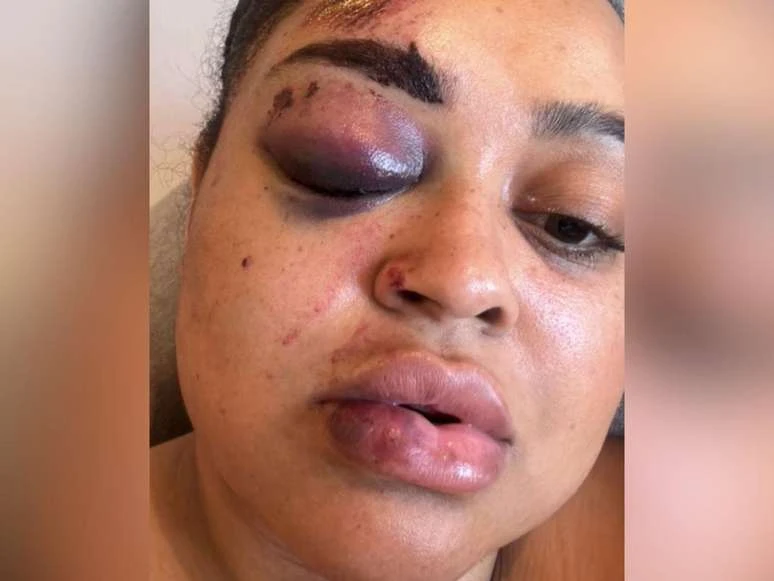 Ex BBB sofre acidente grave e relata apagao Nao lembrava.webp