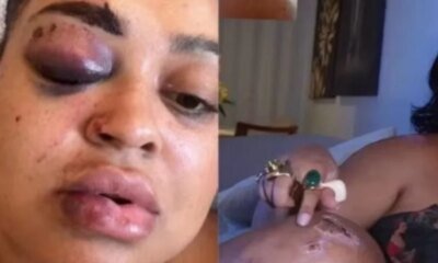 Ex BBB surge irreconhecivel apos grave acidente ‘Eu nao lembrava de