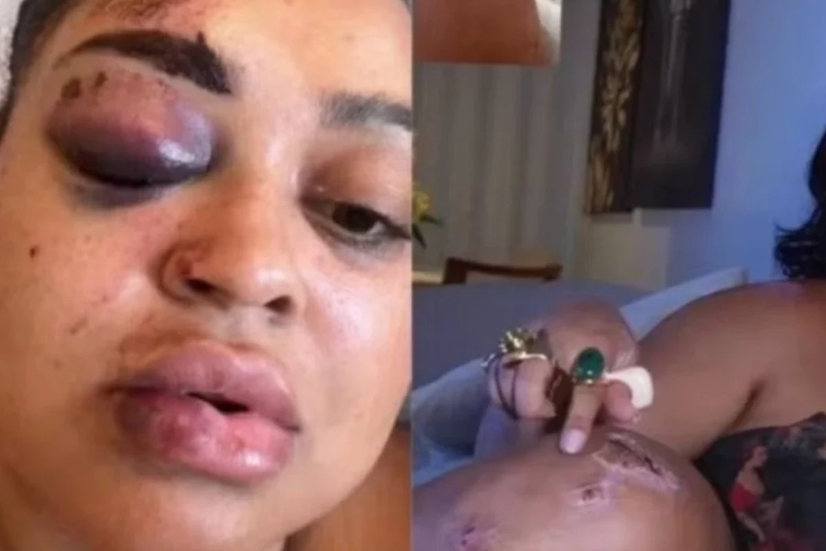 Ex BBB surge irreconhecivel apos grave acidente ‘Eu nao lembrava de