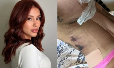 Influencer afirma ter sido deformada por clinica estetica.webp