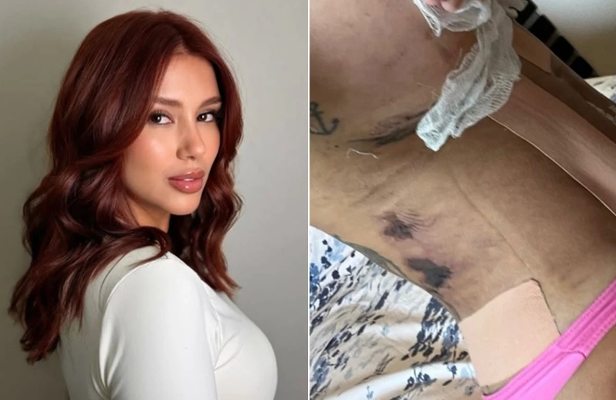 Influencer afirma ter sido deformada por clinica estetica.webp