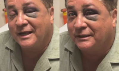 Leonardo aparece com olho roxo e deixa fas em choque