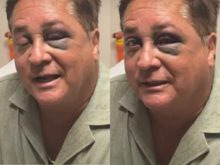 Leonardo aparece com olho roxo e deixa fas em choque