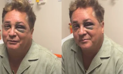 Leonardo sofre acidente e aparece com olho roxo nas.webp