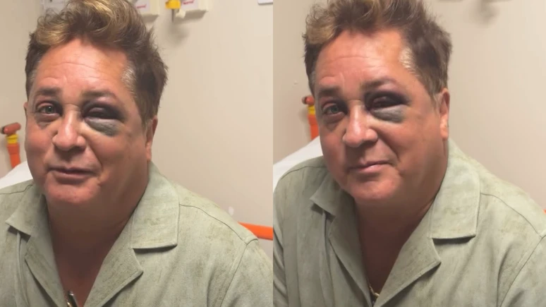 Leonardo sofre acidente e aparece com olho roxo nas.webp