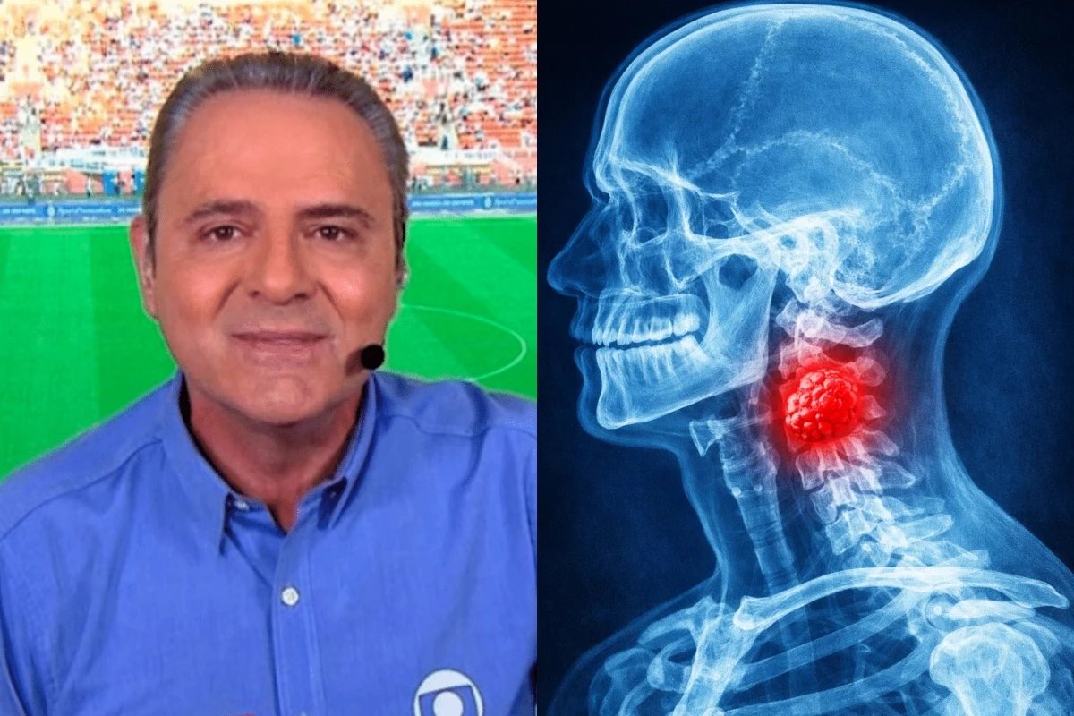 O que e uma neoplasia cervical Doenca descoberta durante
