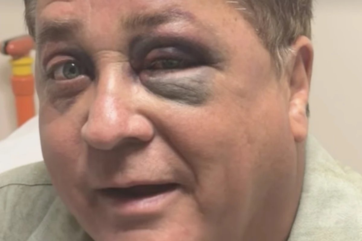 Poliana Rocha desabafa apos Leonardo aparecer com olho roxo susto