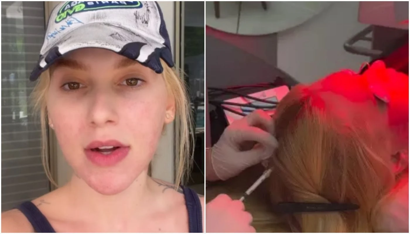 Virginia revela diagnostico de alopecia areata e faz desabafo.webp