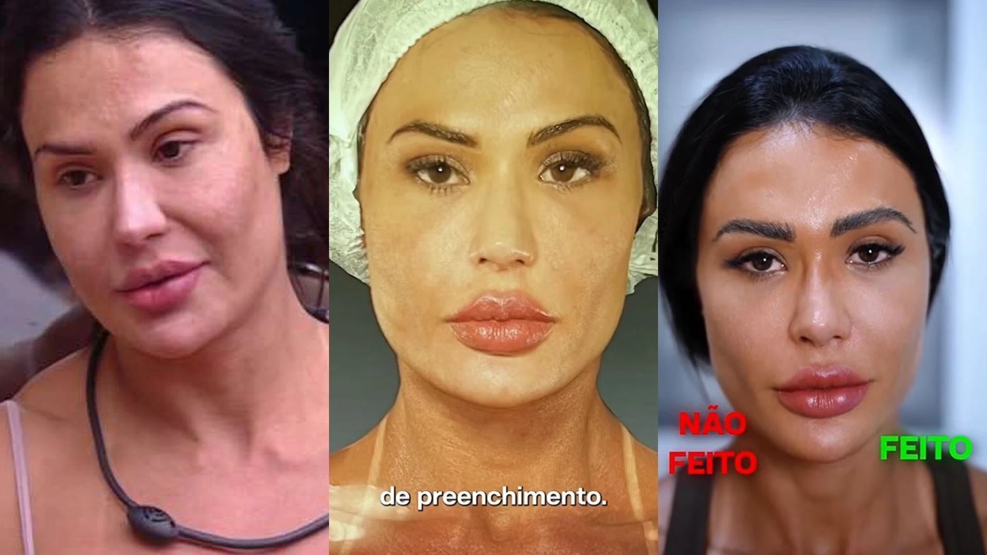 veja ex BBBs que reverteram procedimentos.webp