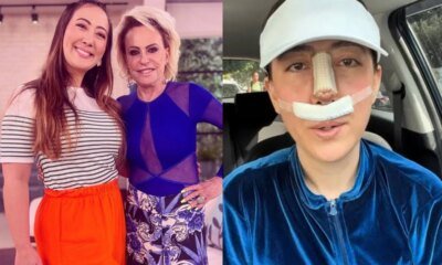 Apos quase perder o nariz reporter do Mais Voce faz