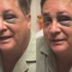 Foto de Leonardo com hematomas no rosto viraliza e Poliana