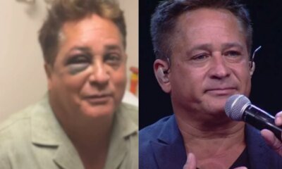 Leonardo sofre acidente fratura o rosto e estado de saude