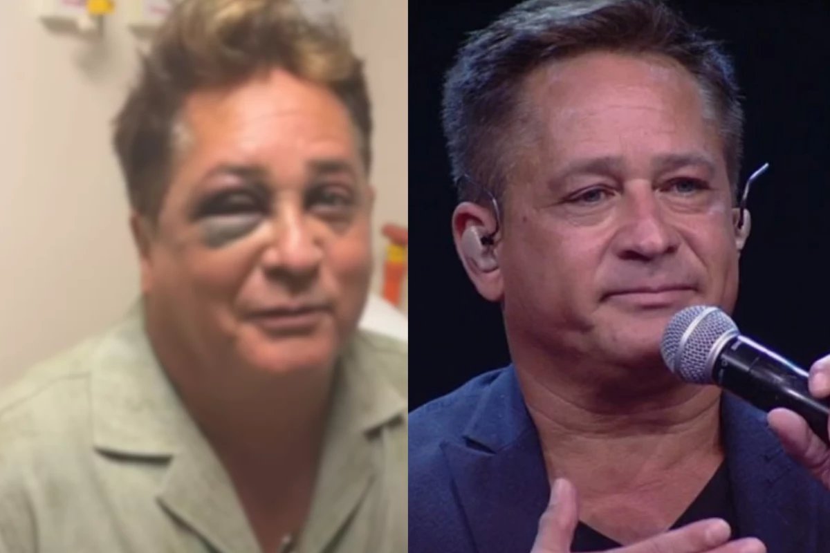 Leonardo sofre acidente fratura o rosto e estado de saude