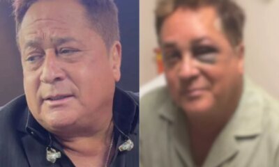 Leonardo surge com olho roxo apos sofrer acidente e explica