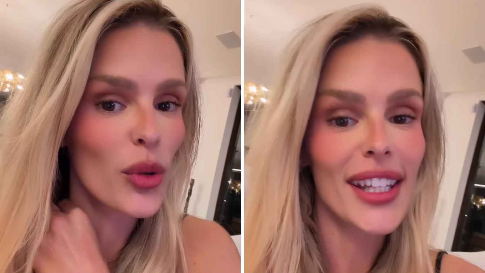 Yasmin Brunet revela que descobriu lipedema de forma inusitada.webp
