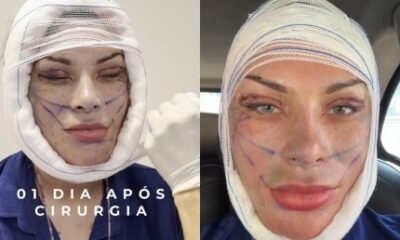 Andressa Urach revela antes e depois de transformacao facial veja