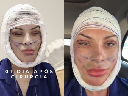 Andressa Urach revela antes e depois de transformacao facial veja