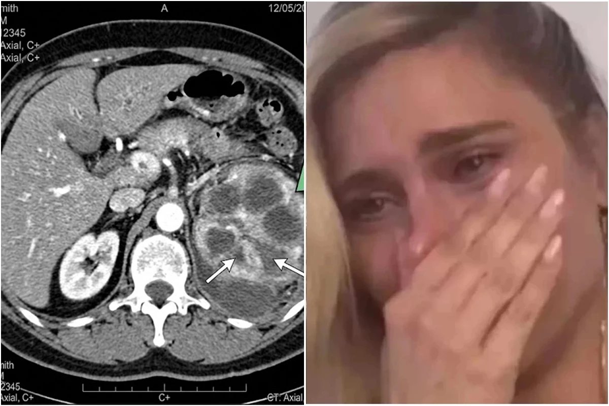 Esta e a doenca em estagio avancado que afetou a
