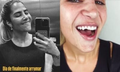 Filha de Leonardo Jessica Beatriz mostra dente quebrado apos queda