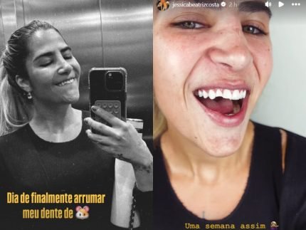 Filha de Leonardo Jessica Beatriz mostra dente quebrado apos queda