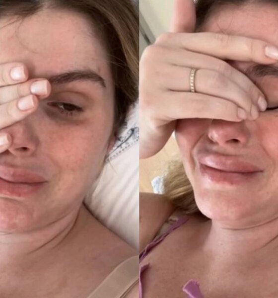 Filho de Barbara Evans sofre acidente domestico leva ponto na