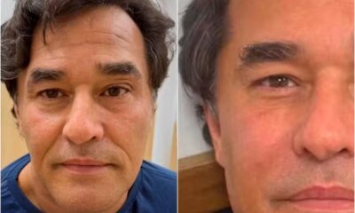 Foi assim que Luciano Szafir ficou depois da harmonizacao facial
