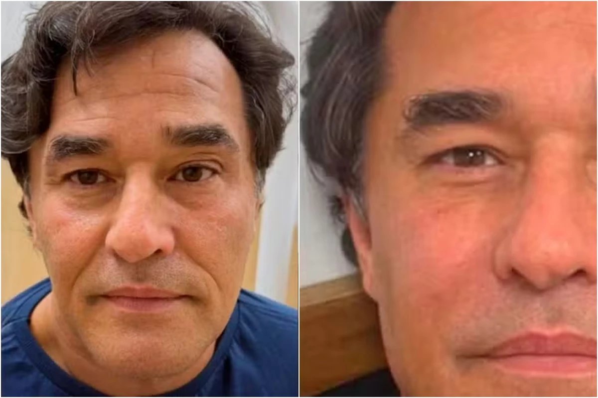 Foi assim que Luciano Szafir ficou depois da harmonizacao facial