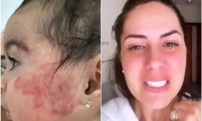 Foi isso que teria causado surgimento de nodulos na filha