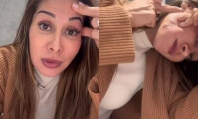 Maira Cardi choca ao exibir danos de PMMA no rosto