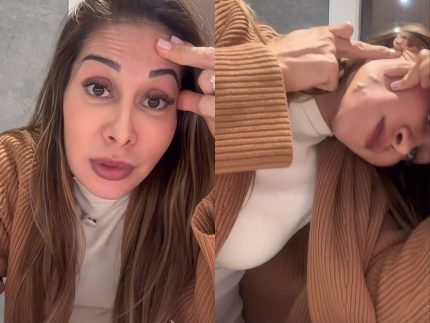 Maira Cardi choca ao exibir danos de PMMA no rosto