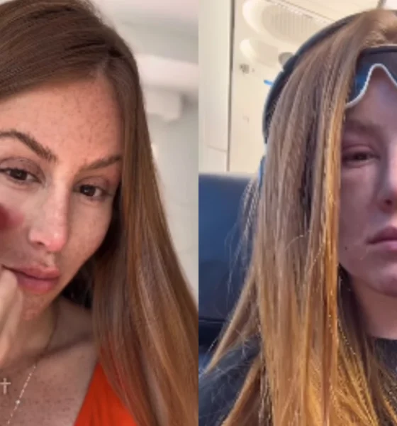 Mari Maria usa laser para tratar tumores nos olhos.webp
