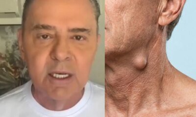 Caroco no pescoco levou Luis Roberto a descobrir cancer ele