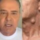 Caroco no pescoco levou Luis Roberto a descobrir cancer ele