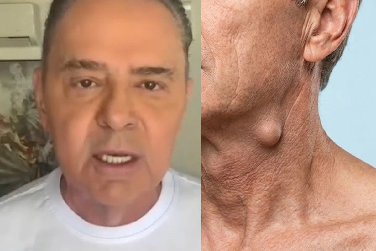 Caroco no pescoco levou Luis Roberto a descobrir cancer ele