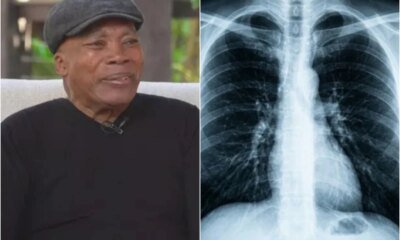 Este e o problema de saude de Milton Nascimento cantor