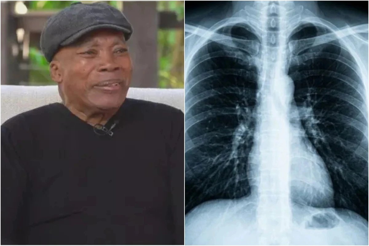 Este e o problema de saude de Milton Nascimento cantor